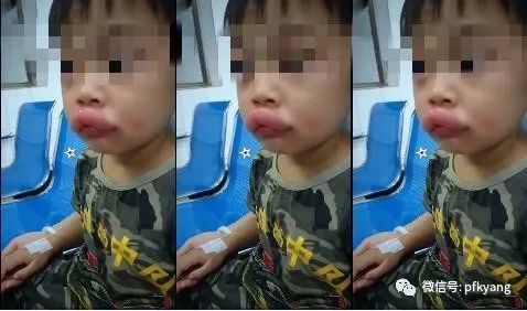 男孩吃葡萄過(guò)敏腫成嘟嘟嘴怎么回事？畫(huà)面詳情曝光網(wǎng)友忍不住笑了