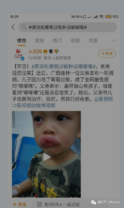 男孩吃葡萄過敏腫成嘟嘟嘴怎么回事？畫面詳情曝光網(wǎng)友忍不住笑了(圖3)